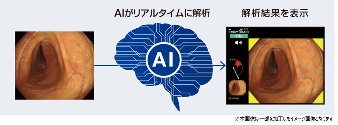 AI内視鏡