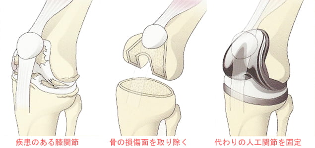 人工関節置換術｜三郷中央総合病院