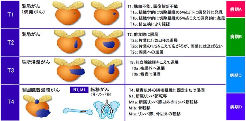 前立腺癌の病期分類